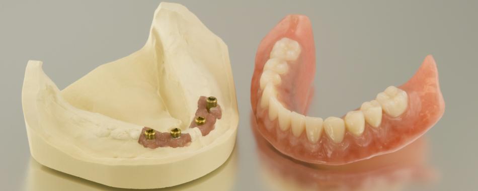 Мини-импланты зубов: виды и их особенности.