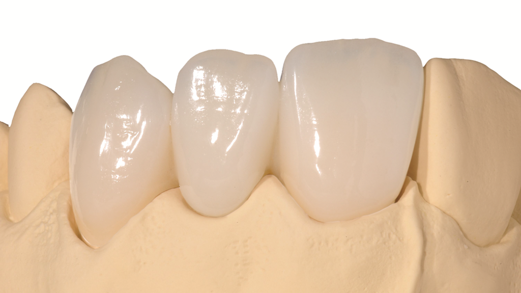 Какие коронки E-max устанавливают на передние зубы?