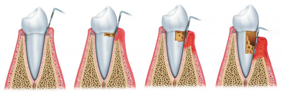 Стоимость гингивэктомии в области одного или нескольких зубов.