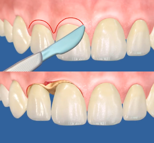 Методы проведения гингивэктомии зуба.