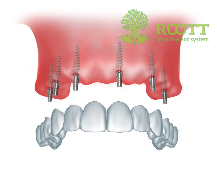 Зубные импланты ROOTT: преимущества имплантов.