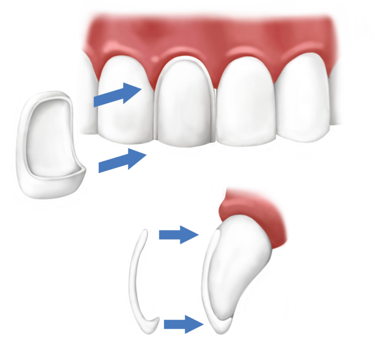 Керамические виниры: эстетическая реставрация зубов.