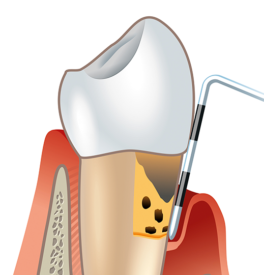 Как проходит прием у стоматолога-пародонтолога?