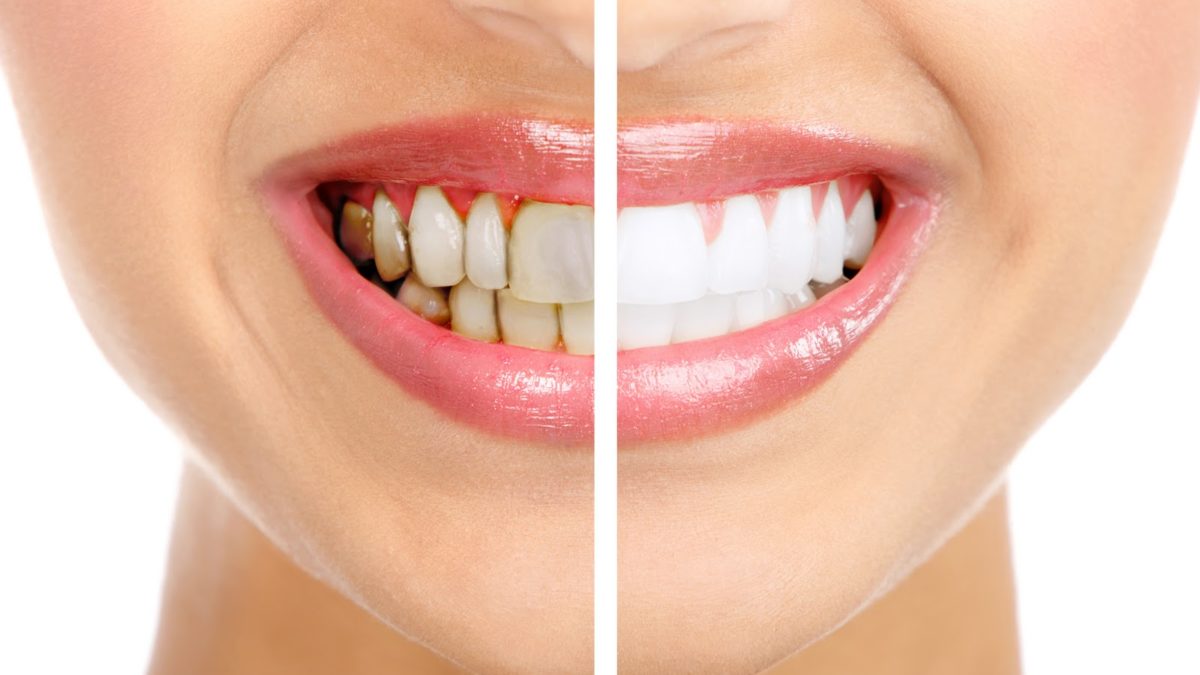Внутриканальное отбеливание зуба: показания к процедуре.