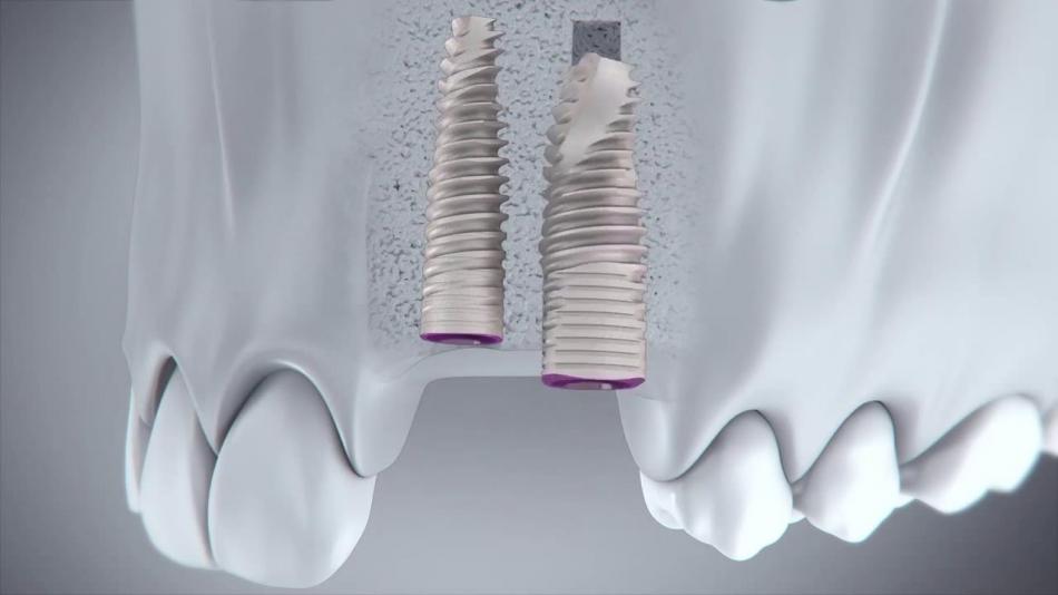 Стоимость израильских зубных имплантов MIS.
