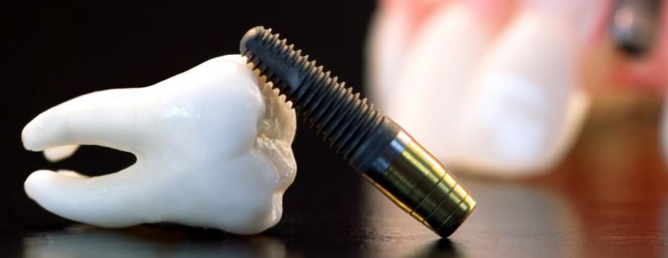 Системы имплантов зубов Osstem: стоимость установки.
