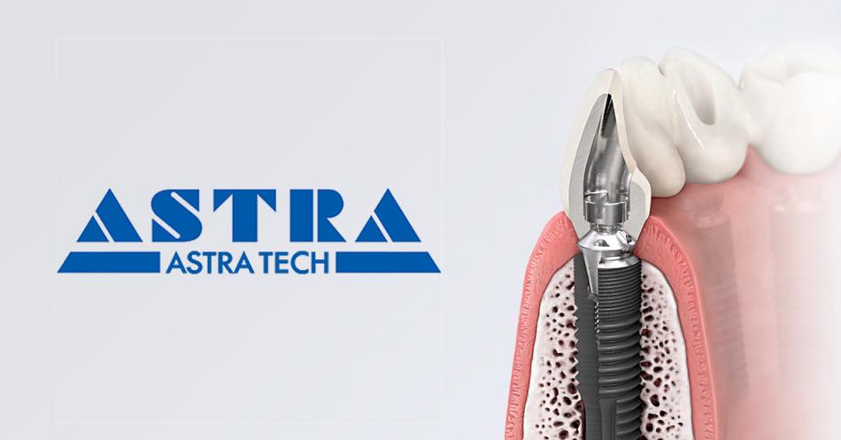 Особенности имплантатов Astra Tech.