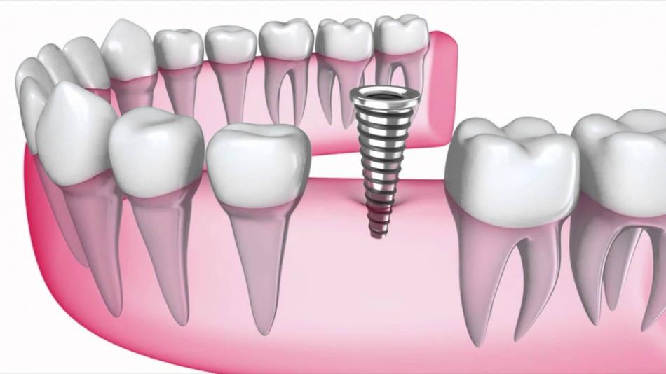 Имплант AB Dental: отзывы пациентов о системах