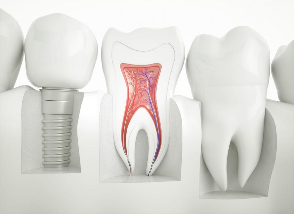 AB Dental Devices Израиль - надежные имплантаты