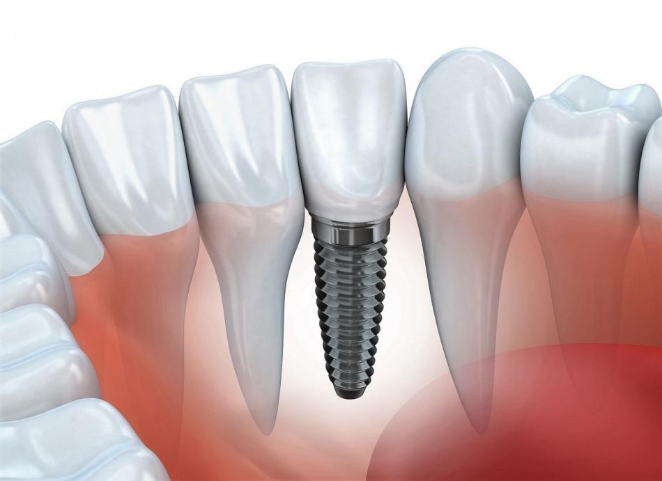 Импланты AB Dental: характеристики систем