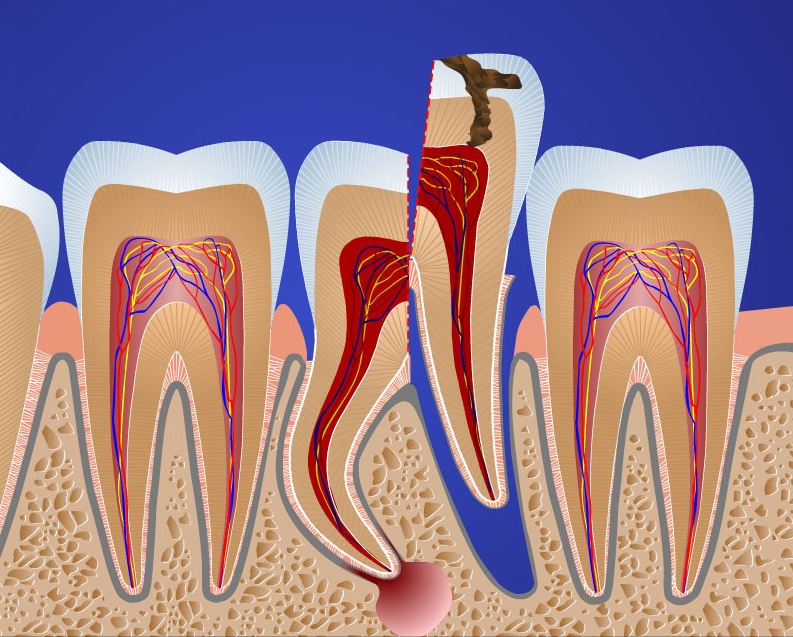 Сколько стоит операция гемисекции зуба?